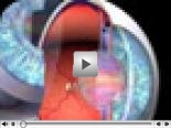 As� se produce un glaucoma