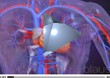As� se produce un infarto de miocardio