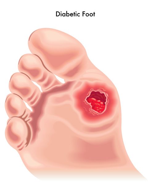 Management of Diabetic Foot Ulcers – PubMed Central (PMC)