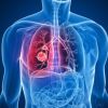 Neumonía, diagnóstico de las infecciones respiratorias