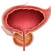 Hiperplasia o adenoma de próstata: causas, síntomas y tratamientos