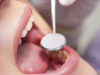 Dientes nuevos: implantes en 24 horas