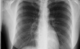 Origen y fases del cáncer de pulmón