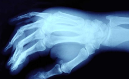 Causas más frecuentes de dolor en la mano