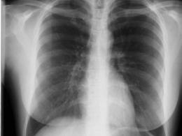 Origen y fases del cáncer de pulmón