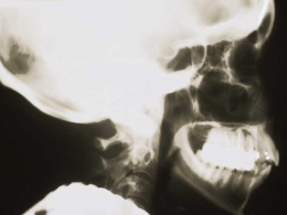 Disfunción de la articulación temporomandibular