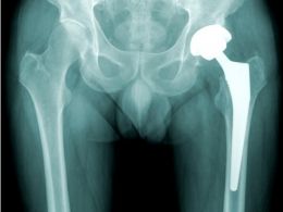 Implantación de una prótesis de cadera