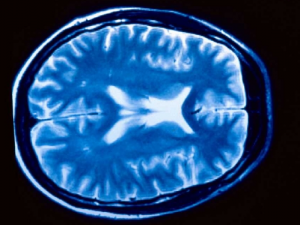 Enfermedad vascular cerebral