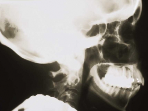 ¿Cómo se colocan los implantes dentales?