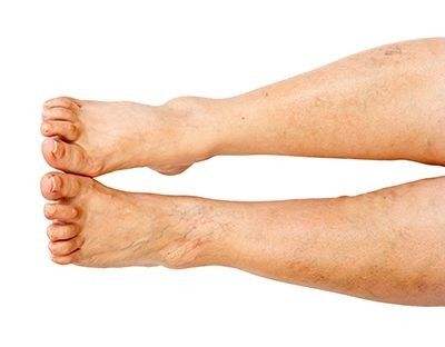 ¿Puedes tener neuropatía periférica en un solo pie?
