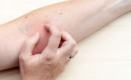 Fluocinolona acetónido (vía tópica)