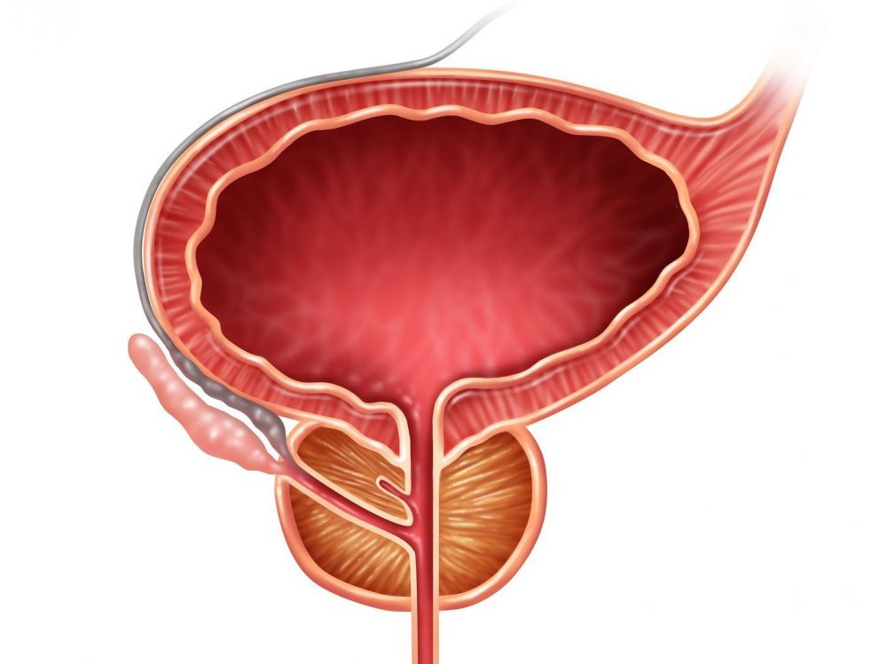 Prosztata adenoma enukleáció