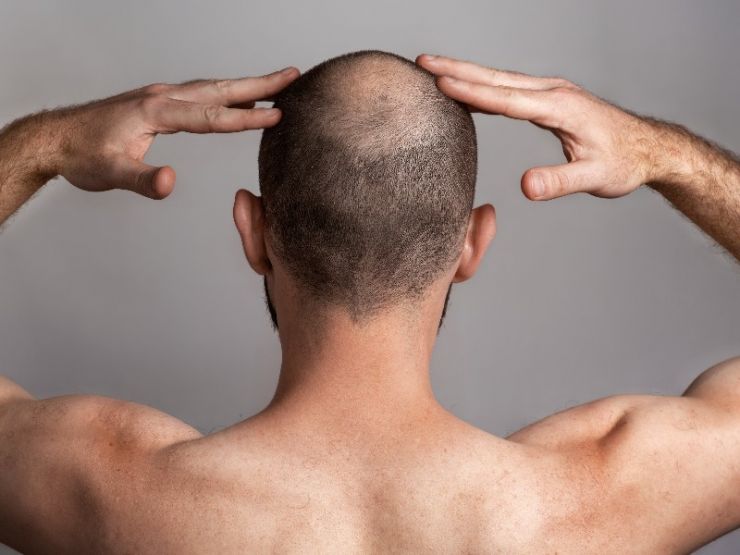 ¿Qué tipos de alopecia existen y cómo se pueden tratar?