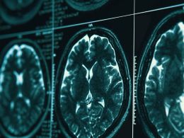 Los 5 últimos descubrimientos sobre el Alzheimer