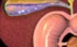 ¿Por qué se forman los cálculos en la vesícula?