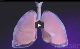 ¿Por qué se produce un neumotórax?