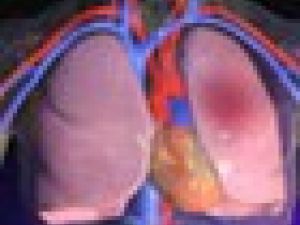 Por qué se produce una embolia pulmonar