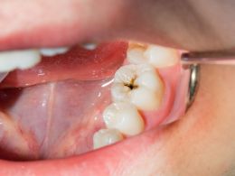 Trucos para prevenir la aparición de caries