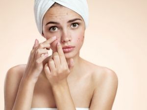 Remedios caseros para eliminar y prevenir el acné