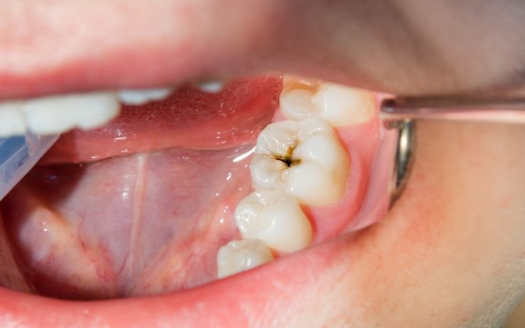 Trucos para prevenir la aparición de caries