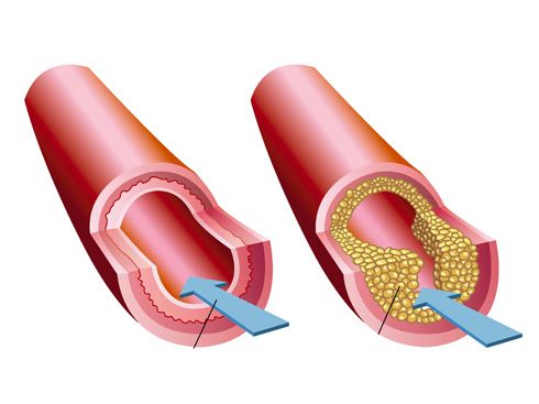 Arteria anormal