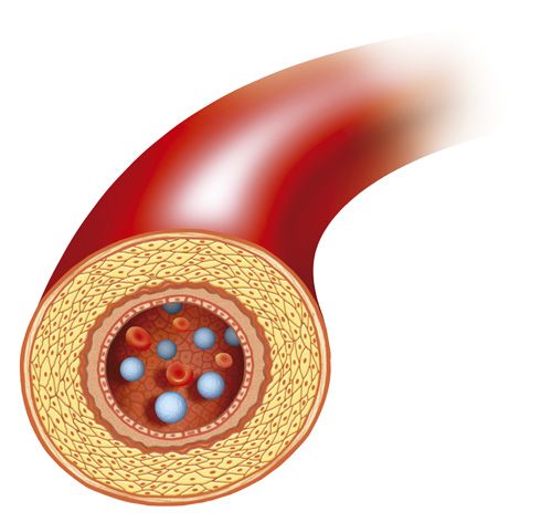 Ateroma arterial