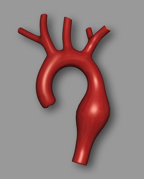 Disección aorta