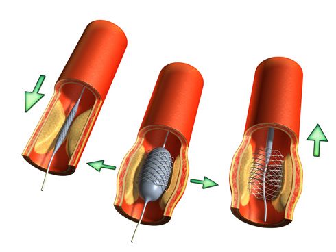 Prótesis aorta