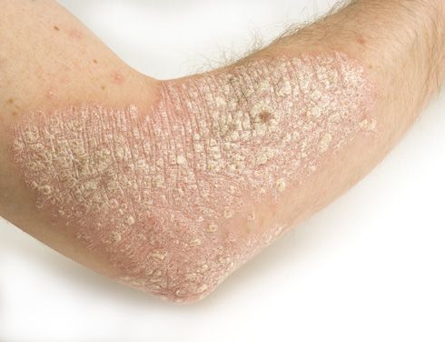 Psoriasis