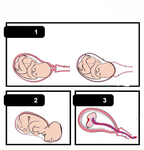 Fases del parto