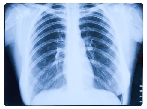 Radiología de los pulmones