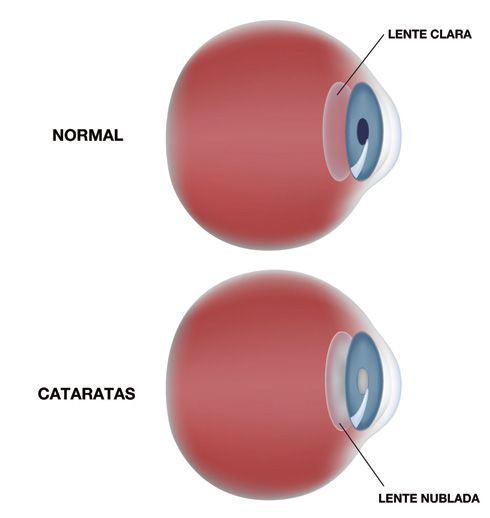 Catarata