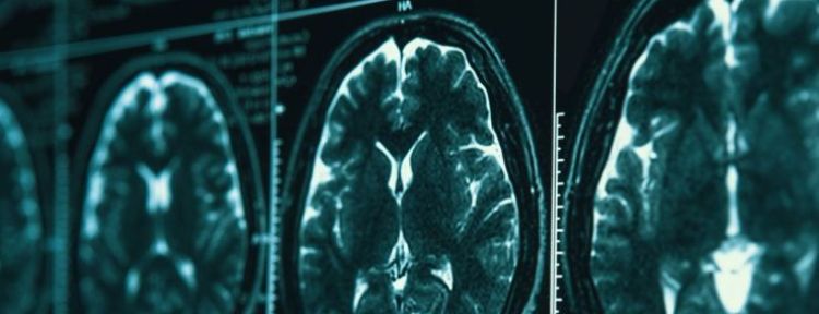 Los 5 últimos descubrimientos sobre el Alzheimer