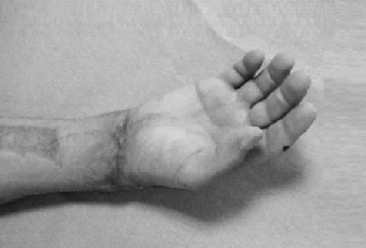 Se realiza con éxito la reimplantación de una mano