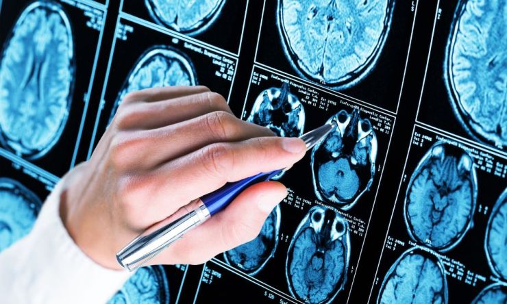 El primer test español para hallar el Alzheimer en sangre llegará a finales de 2023